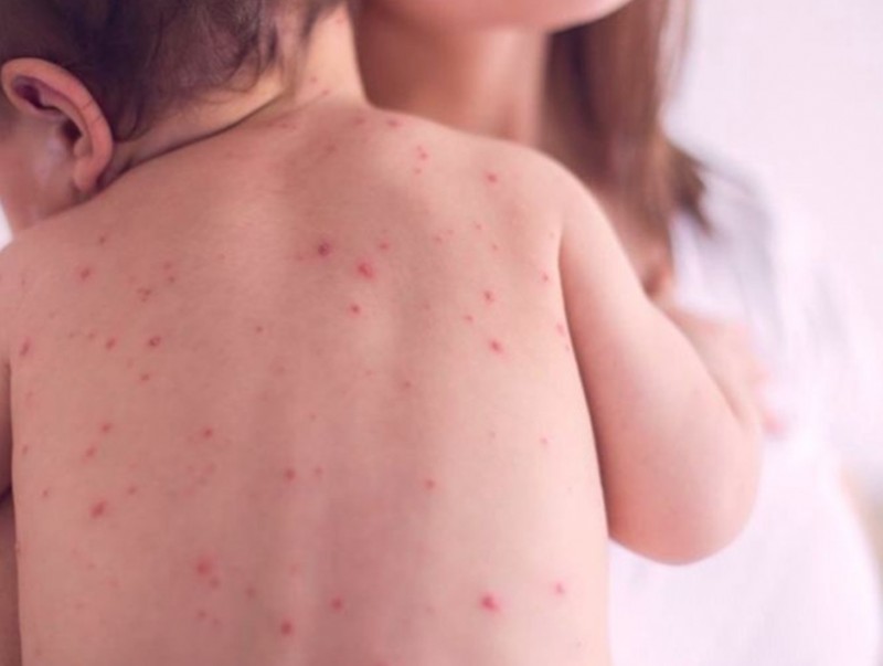 ХӨСҮТ: Улаанбурхан өвчний нийт батлагдсан тохиолдол 13378 болжээ